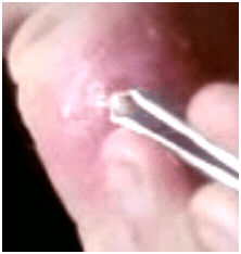 fibrinpusplug1