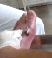 infectedfootinbrazil1