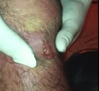 kneefurunculo1