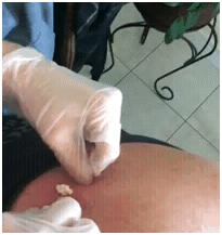 myunclesbigcyst1 myunclesbigcyst1