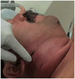 neckabscesssurgeryprep1 neckabscesssurgeryprep1