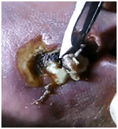 necroticspiderbite1 necroticspiderbite1