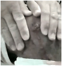 oozinginfectedknee1 oozinginfectedknee1