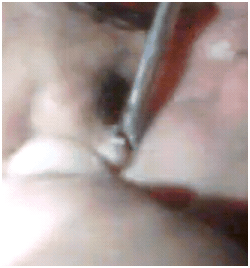 pimpleinsideear1