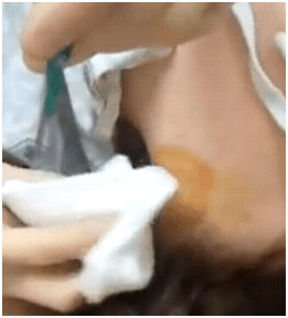 pluggedsebacgland1 pluggedsebacgland1