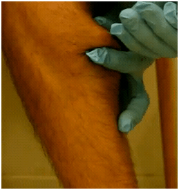 poppingalegcystagain1