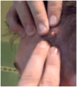 poppingboilforehead2