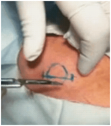 ChVdirofilariacyst01272012A
