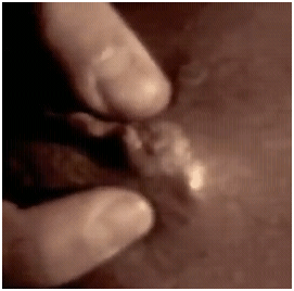 africaninfection01232012A