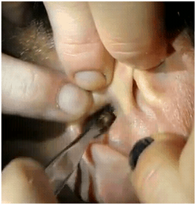 earwaxremoval01202012A earwaxremoval01202012A