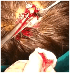 halimgracepilarcyst01192012A halimgracepilarcyst01192012A