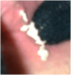 hugepimplecystpttwo01222012E hugepimplecystpttwo01222012E