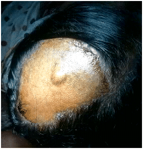 implantationcyst01132012B implantationcyst01132012B