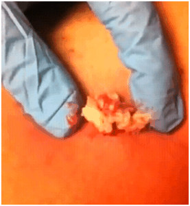 inhousecystsurgery01282012A inhousecystsurgery01282012A