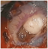 microsurgicalbraintumor01282012A microsurgicalbraintumor01282012A