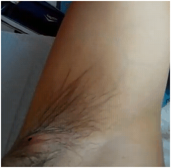 underarmabscessvideo17_1 underarmabscessvideo17_1