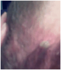 joshskillercyst02122012A joshskillercyst02122012A