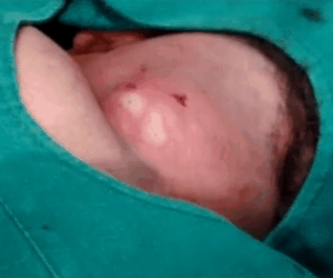 surgeryonlargeinfectedsebaceouscystneck02132012A surgeryonlargeinfectedsebaceouscystneck02132012A