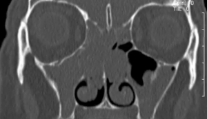 endoscopicshavingofnasalpolyps01272013B