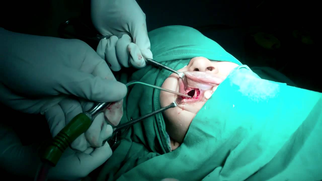 Nasal Polyps surgical treatment manner
