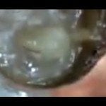 Removing Blackheads Under High Magnification