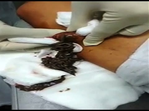 40-Years-old Black Cyst