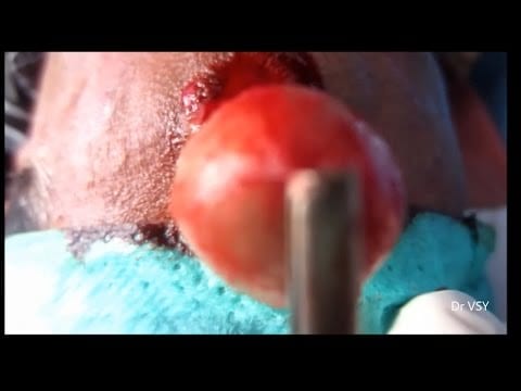Oh Boy, Big Forehead Cyst