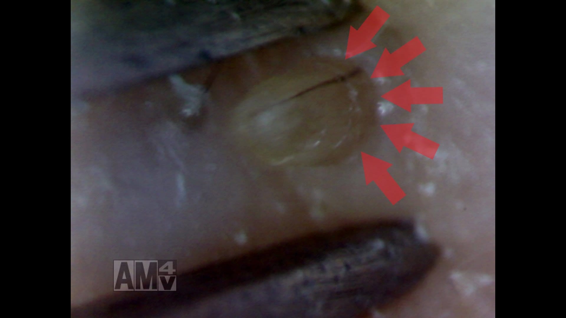 Pops out of the Pore