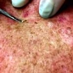 Neck Blackheads