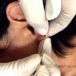 Ear Lobe Blackhead. . .